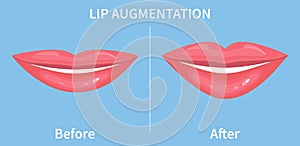 Lip Augmentation. Before and after lip filler injections. Vector illustration