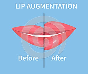 Lip Augmentation. Before and after lip filler injections. Vector illustration