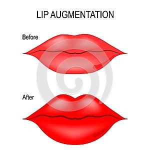 Lip Augmentation. Vector illustration photo