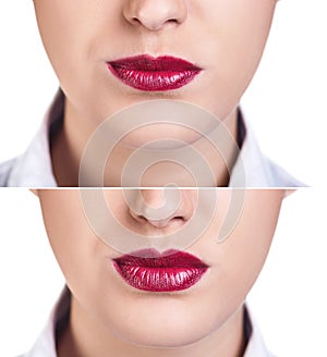 Before and after lip filler injections.