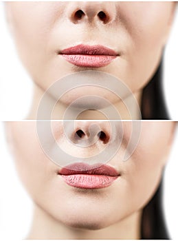 Before and after lip filler injections.