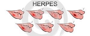 Lip herpes. bladder, inflammation