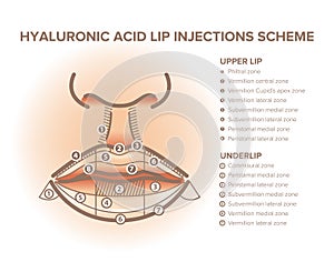 Lip injections. Lip anatomy poster. Hyaluronic acid filler