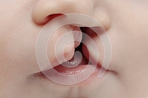Lip and palate cleft photo