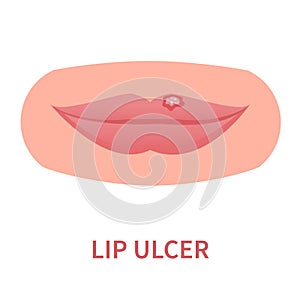 Lip ulcer blister inflammation outbreak medical icon