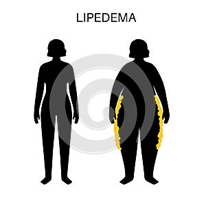 Lipedema fat zones