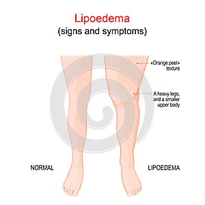 Lipoedema or Lipedema