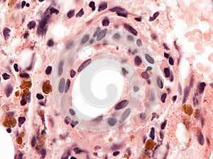 Lipogranuloma. Bone marrow. photo
