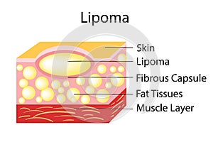 Lipoma are adipose tumors located in the subcutaneous tissues.