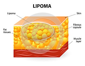 Lipoma photo