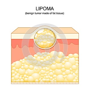 Lipoma. adipose tumors. Skin layers photo