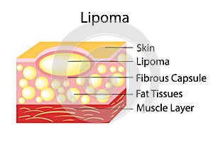 Lipoma are adipose tumors located in the subcutaneous tissues. photo