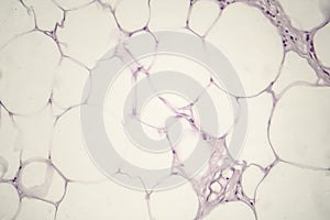 Lipoma, benign growth of fatty tissue