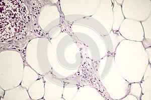 Lipoma, benign growth of fatty tissue