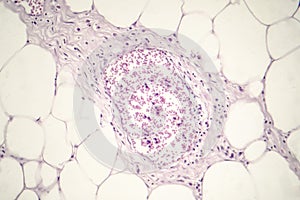 Lipoma, benign growth of fatty tissue