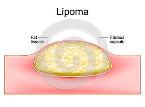 Lipoma. Cross section of a human skin photo