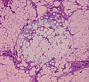 Lipoma on cubital fossa, benign growth of fatty tissue, benign neoplasm, adipocytes, partially capsulated tumor. photo