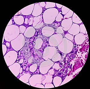 Lipoma on cubital fossa, benign growth of fatty tissue, benign neoplasm, adipocytes, partially capsulated tumor, photo