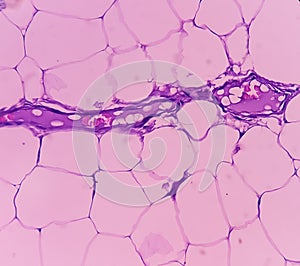 Lipoma on cubital fossa, benign growth of fatty tissue, benign neoplasm, adipocytes, partially capsulated tumor, 40x microscopic v photo