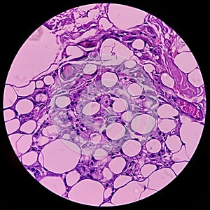Lipoma on cubital fossa, benign growth of fatty tissue, benign neoplasm, adipocytes, partially capsulated tumor. photo