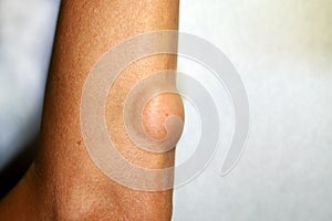 Lipoma on the elbow of the arm photo
