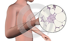 Lipoma, a growth of fat tissue under human skin