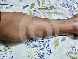 Lipoma knots on the left forearm of a young man