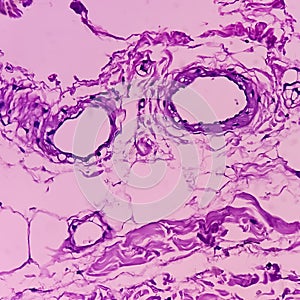 Lipoma on loin, benign growth of fatty tissue, benign neoplasm, adipocytes, partially capsulated tumor,