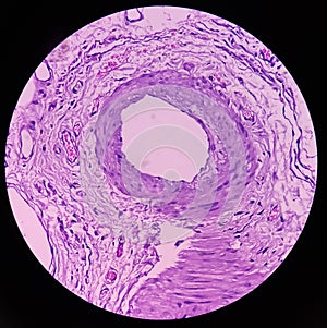 Lipoma on loin, benign growth of fatty tissue, benign neoplasm, adipocytes, partially capsulated tumor.