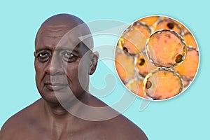 Lipoma on a man's forehead, 3D illustration