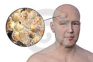 Lipoma on a man's forehead, 3D illustration photo