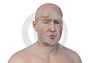 Lipoma on a man's forehead, 3D illustration. photo