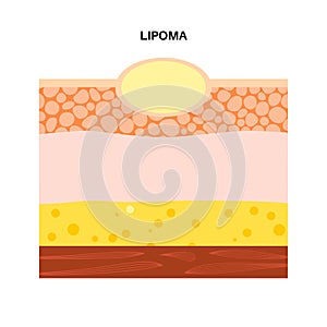 Lipoma medical poster