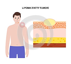 Lipoma medical poster