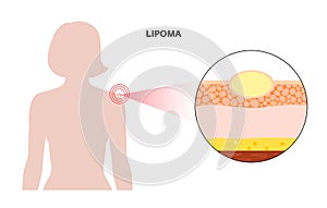 Lipoma medical poster photo