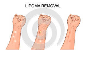 Lipoma. removal of lipoma on forearm
