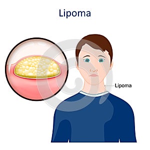 Lipoma. Skin disease photo