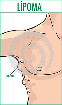 Lipoma.