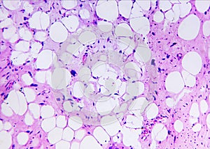 Liposarcoma of a human