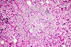 Liposarcoma, soft tissue sarcoma