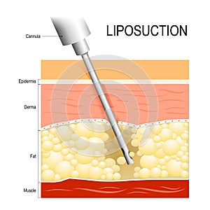 Liposuction. Cannula into the fat layer beneath skin. photo