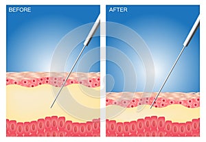 Liposucción antes a después  gordo   cirugía  perfecto liposucción 