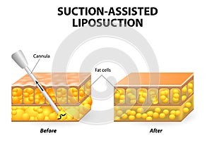 Liposukcia 