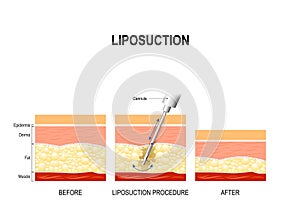 Liposuction procedure. Before and after photo