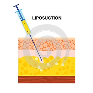 liposuction surgery procedure