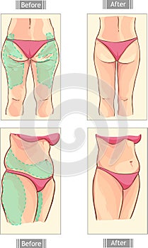 Liposuction