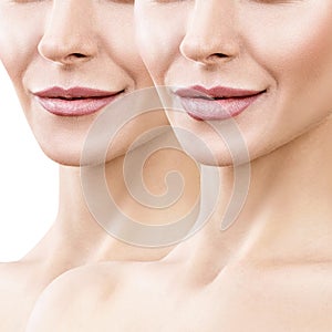 Lips of adult woman before and after augmentation