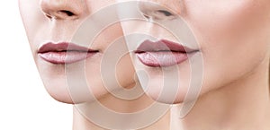 Lips of adult woman before and after augmentation