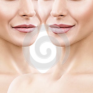 Lips of adult woman before and after augmentation