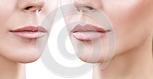 Lips of adult woman before and after augmentation